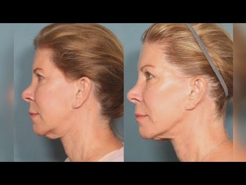 Sofwave: A Summer-friendly & needle-free way to treat wrinkles